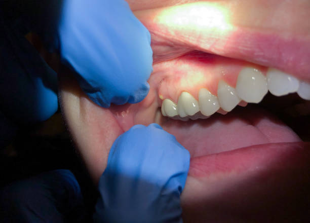 Best Lost Filling or Crown Replacement in West Valley City, UT